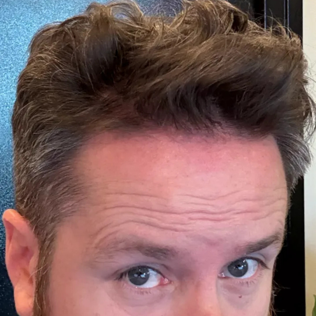 5. After 6 months: more hair than when you were 20