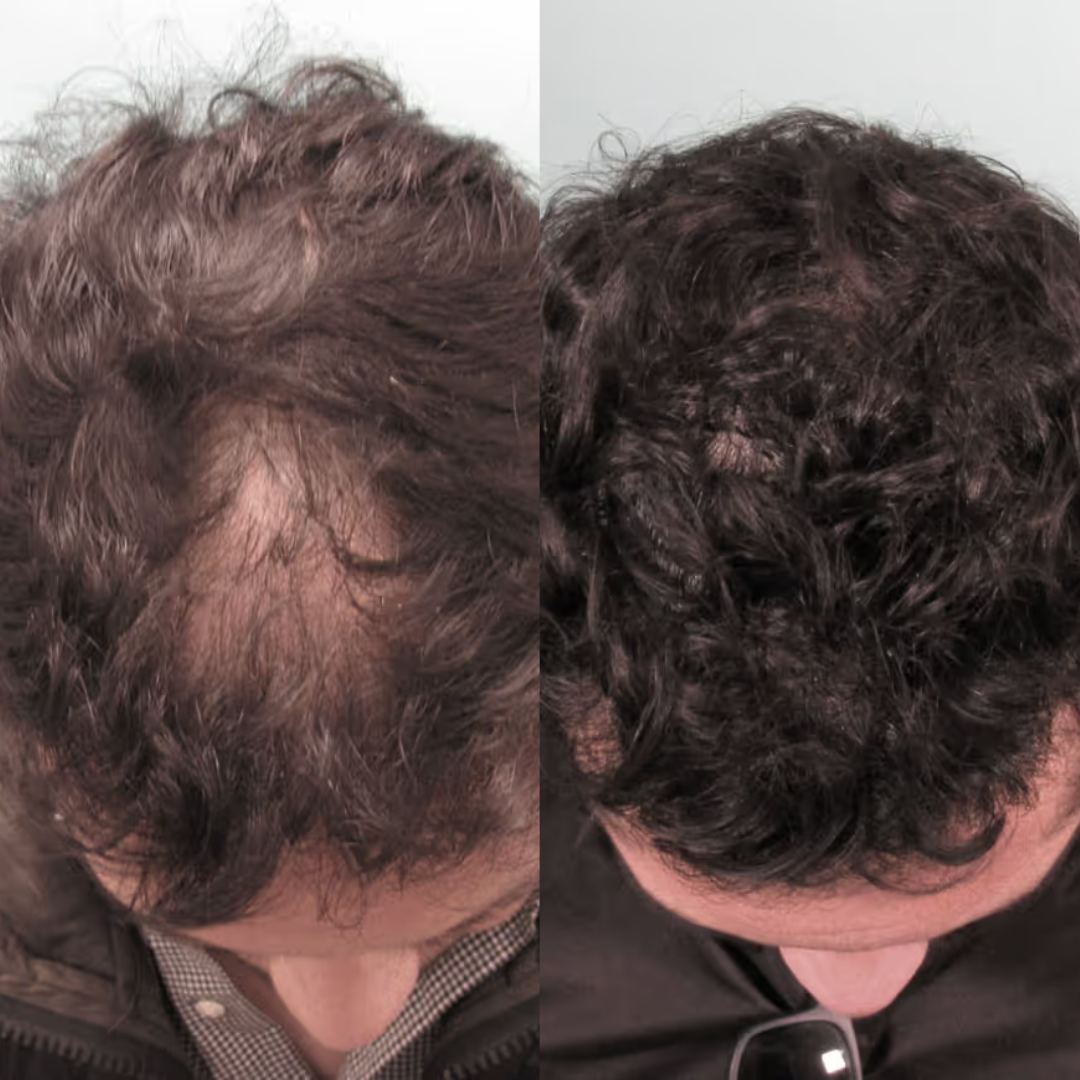 2. Less hair in the drain — within a week